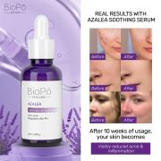 Azalea Acne Treatment BioPo Serum